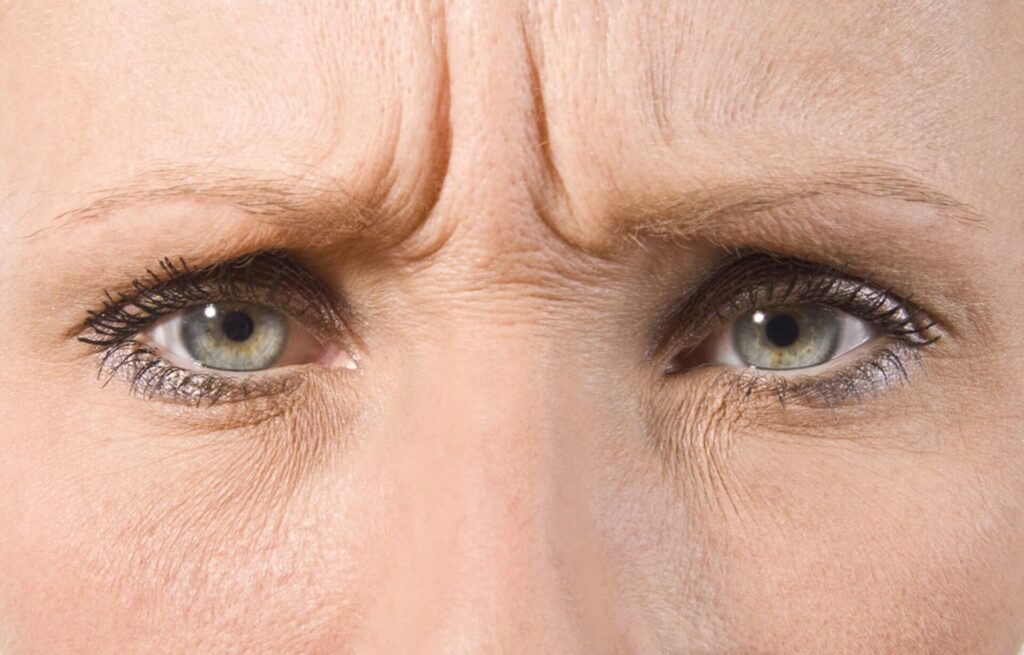 Arrugas de expresión