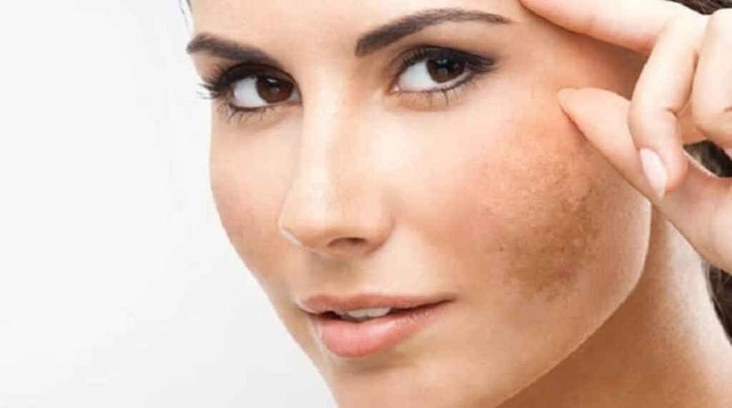 Tratamiento de manchas