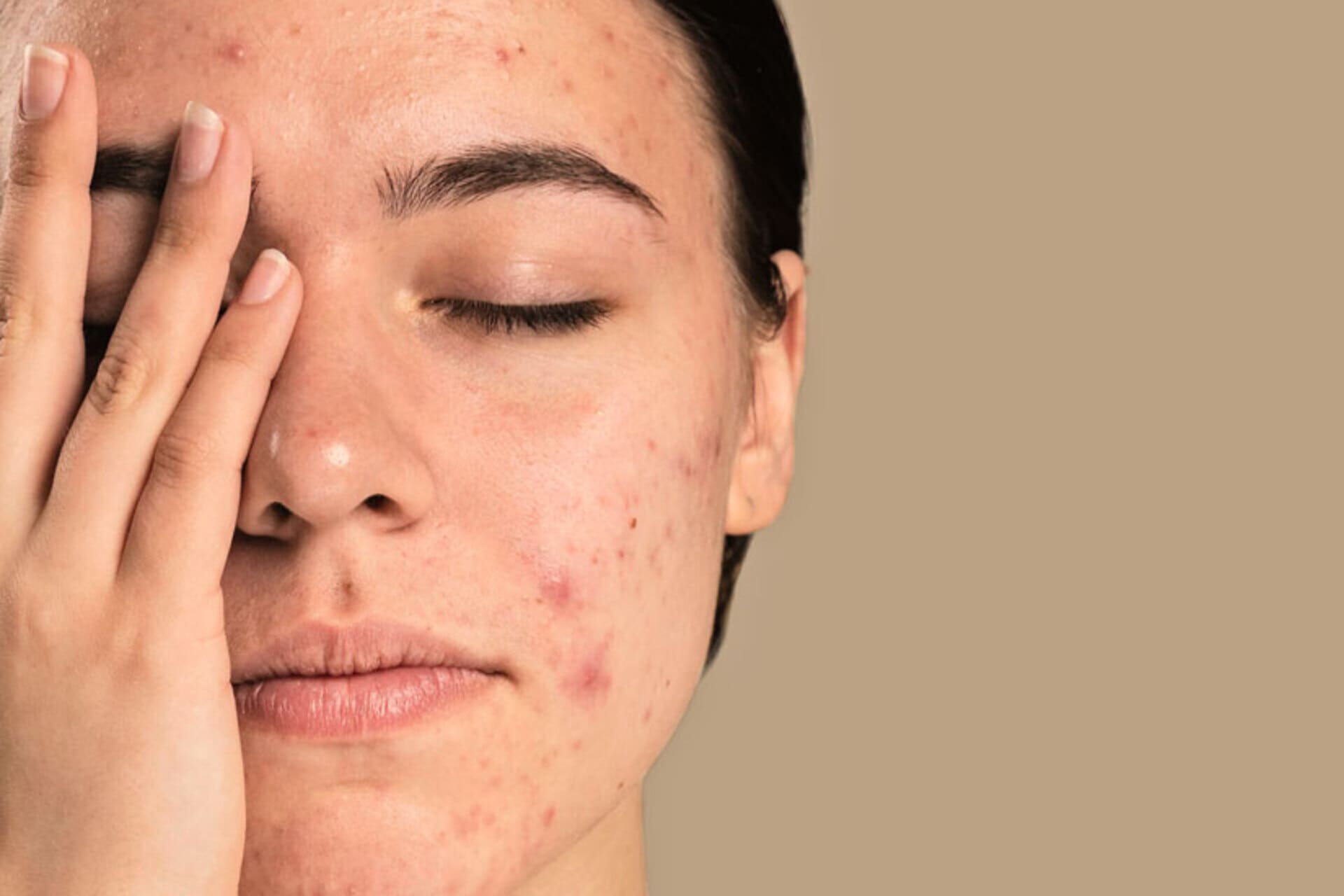 Tratamiento de acné