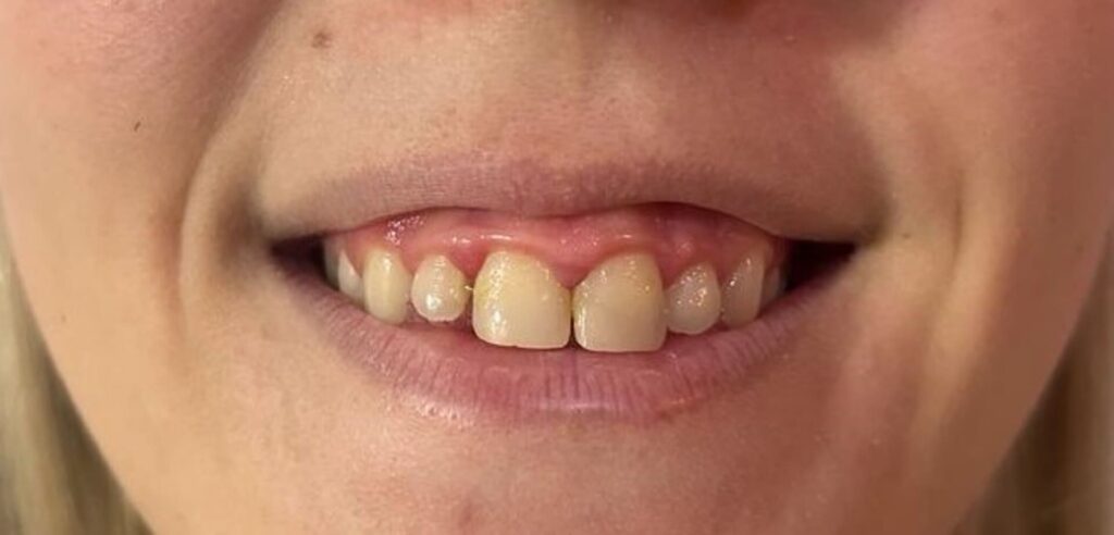 Sonrisa gingival